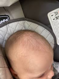 This condition is very common in newborns but could as well affect adults. How To Get Rid Of Cradle Cap Naturally Lovely Lucky Life
