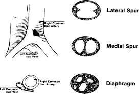 Intravascular Ultrasound In The Diagnosis And Treatment Of Iliac Vein Compression May Thurner Syndrome Journal Of Vascular And Interventional Radiology