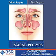 Nasal polyps are fairly common and often have no symptoms. Our State Of The Art Technologies And Equipment Like Karl Storz Nasal With Hd Operating Cameras And Hitech Zeiss Sensera Micros Polyp Polyps Symptoms Hospital