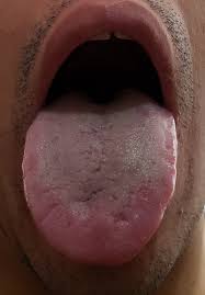 Mi Lengua Esta Normal Ayer La Tenia Un Poco Mas Blanca Comi Algo Y Fue Rosa