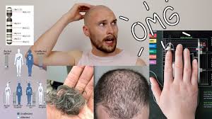 Reasons you face hair loss What Are The Early Signs Of Male Pattern Baldness Youtube