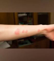 Image result for flea bites