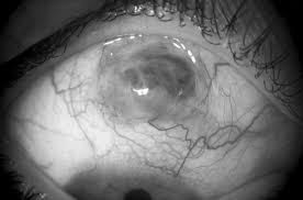Image result for lesion sclera