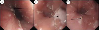 Extensive comorbidity is the hallmark of immunodeficiencies. Diagnosis And Treatment Of Esophageal Candidiasis Current Updates