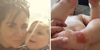 He does not have active infection, these rashes are not related to hsv. Don T Kiss Your Kids When You Re Sick Mom Warns Baby Gets Herpes After Contact With Cold Sore