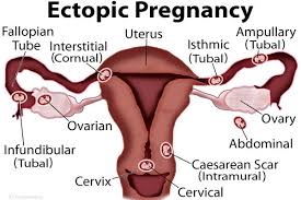Sejumlah gejala sakit perut sebelah kiri akibat kista ovarium yang harus diwaspadai adalah perdarahan berlebih saat menstruasi, sakit perut bagian kiri bawah, nyeri di tulang panggul, hingga kesulitan buang air kecil dan besar. Kerap Sakit Perut Bahagian Kiri Bawah Ia Mungkin Perkara Biasa Tapi Ini 11 Puncanya Yang Anda Tidak Boleh Abaikan Siakap Keli News