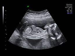 Sneakpeek clinical is an early baby gender test offered to women starting at 8 weeks into pregnancy from the comfort of an ultrasound studio near you. Gender Scan Ultrasounds In The Uk Ultrasound Plus