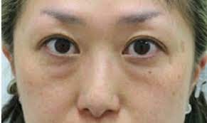 目の下のクマはどうしてできる 目の下のクマ 目のくま 目の下