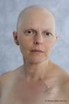 Temporary Hair Loss Stress