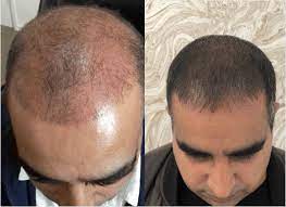 Learn which laser treatments are best for hair growth, scars, etc., and the different types: Laser Hair Regrowth For Men Hair Loss Laser Treatment