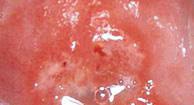 Learn all about how long a period should last here. Urethritis Causes Treatment Prevention
