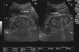 Chronic Renal Failure Renal Failure Renal Disease Chronic Renal Failure