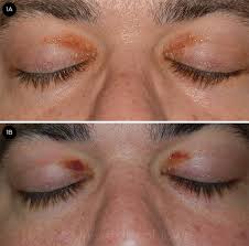 Image result for xanthelasma of eyelid