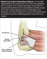 Image result for Elbow Joint Injection