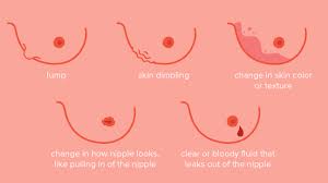 A new lump or lumpiness, especially if it's only in one breast a change in the size or shape of the breast a change to the nipple, such as crusting, ulcer, redness or inversion Breast Cancer Dimpling Tips For Identification