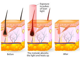 A listing of laser hair removal clinics and technicians located in the state of colorado including addresses and phone numbers. Laser Hair Removal Aesthetics By Design