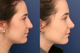 If you are unhappy with the shape, size or angle of your nose. What To Expect Before And After Rhinoplasty Surgery Baltimore