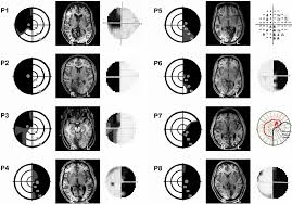 Image result for Visual Field Deficit