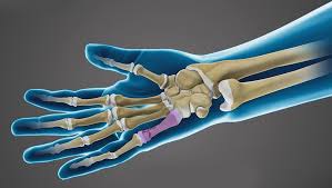 Image result for Hand Fracture