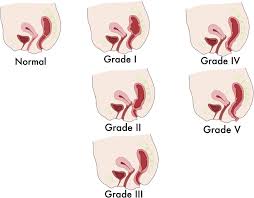 Image result for Rectal prolapse