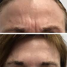 Botox en el entrecejo, antes y después. Toxina Botulinica Botox Usos Y Propiedades Medicina Estetica Barcelona