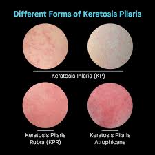 Image result for Keratosis pilaris