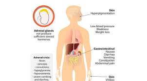 We did not find results for: Penyakit Penyakit Addison Gejala Penyebab Pengobatan Klikdokter Com