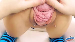 Most Extreme Anal Prolapse and Cervix Prolapse so Far Fist