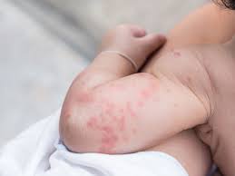 Mit hilfe eines allergietests kann die ursache bestimmt und eine. Eubos Informationen Uber Dermatitis