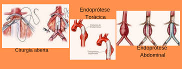 Sempre que existir suspeita de aneurisma ou de rompimento de um aneurisma é muito importante ir imediatamente ao hospital, para fazer os os sintomas de aneurisma de aorta abdominal são mais raros que os da aorta torácica, mas ainda assim pode surgir: Aaa Aneurisma De Aorta Abdominal Taa Aneurisma De Aorta Toracica