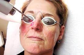 Behandling avhenger av årsakene, men du kan. Kinnene Rosa Nese Hvit Arsaker Og Behandling Av Rode Kinn Hos Voksne Naturlige Arsaker Til Brennende Kinn