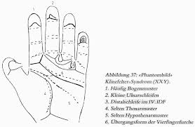 4 Hand Charts For Cri Du Chat Syndrome