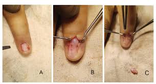 Image result for Glomus tumor