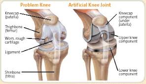 Understand risks, complications, and success and failure rates from our experts. Best Orthopedic Doctors In Malaysia 2021