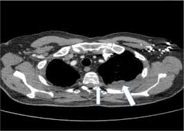 A ct image may show a tumor as a dark mass. Metastatic Biphasic Pleural Mesothelioma Presenting With Cauda Equina Syndrome Sciencedirect