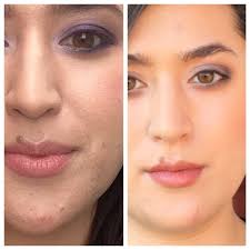 Unlike dry skin, which isn't very prone to acne because it lacks oil, dehydrated skin is a breeding ground for acne because of the overproduction of oils. Faceonomics How I Fixed My Dehydrated Skin