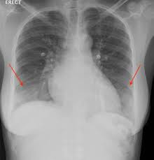 Sickle Cell Anemia Heme Medbullets Step 2 3