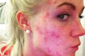 Schoolgirl bullied over her chronic acne thought about killing herself