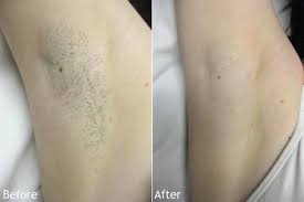 Average Cost Underarm Laser Hair Removal Laser Hair Laser Hair Removal Hair Removal