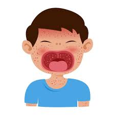 measles disease with maculopapular rash ...