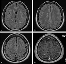 Image result for Brain Lesion