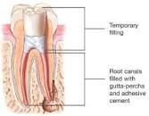 Image result for when do i need root canal treatment