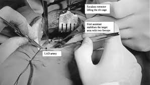 Noting the adaptability of the retractor he was using for internal thoracic artery dissection (the favaloro retractor), he combined its best features with features from a mitral valve retractor designed by denton cooley, md. Minimally Invasive Coronary Artery Bypass Grafting The Rib Cage Lifting Technique Sciencedirect