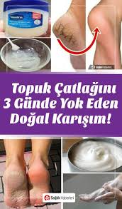 Topuk Catlaklarini 3 Gunde Yok Et Dogal Saglik Saglik Bakim Saglik Urunleri
