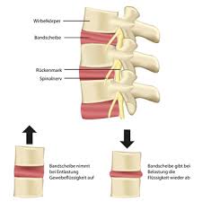 Bandscheiben Anatomie Funktion Schaden Der Bandscheiben