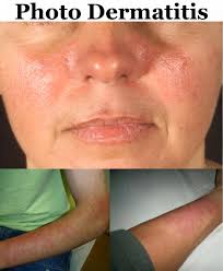 Image result for Photodermatitis