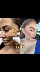 Dear Dr.Aaron Arellano is a great senior surgeon from Mexico 🇲🇽 and  @dr.aaronarellanoruiz visited us last weeks. He observed so many aesthetic  surgery operations such as scarless #facelift, #necklift, #rhinoplasty,  #Abdominoplasty, #breastreduction, #