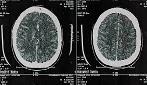 But what is the cost of chemotherapy? The High Cost Of Cancer Treatment