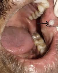 Image result for Labial mucosa