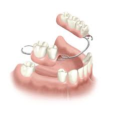 Adakah kerugian dari memasang gigi palsu segera? Gigi Tiruan Dental Id